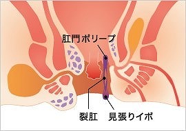 肛門ポリープ