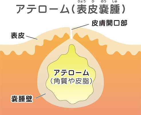 京都で粉瘤 皮下腫瘍の日帰り手術なら 辻クリニック