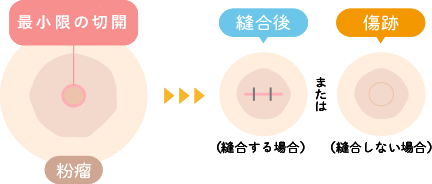 最小限の切開で傷痕が目立たない