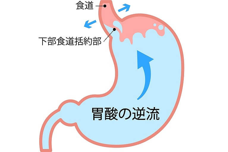 逆流性食道炎