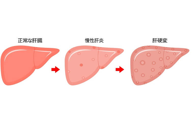 肝硬変